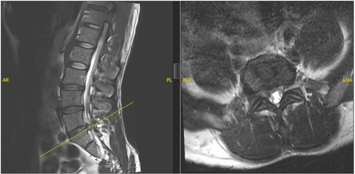 figure-introduction-1 MRI spine scan; sagittal and axial views; vertebral alignment; spinal analysis; anatomical study.
