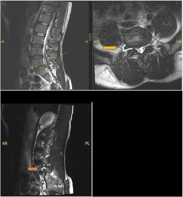 figure-introduction-2 MRI spine images; highlighting herniated disc with arrows; sagittal and axial views; diagnostic tool.