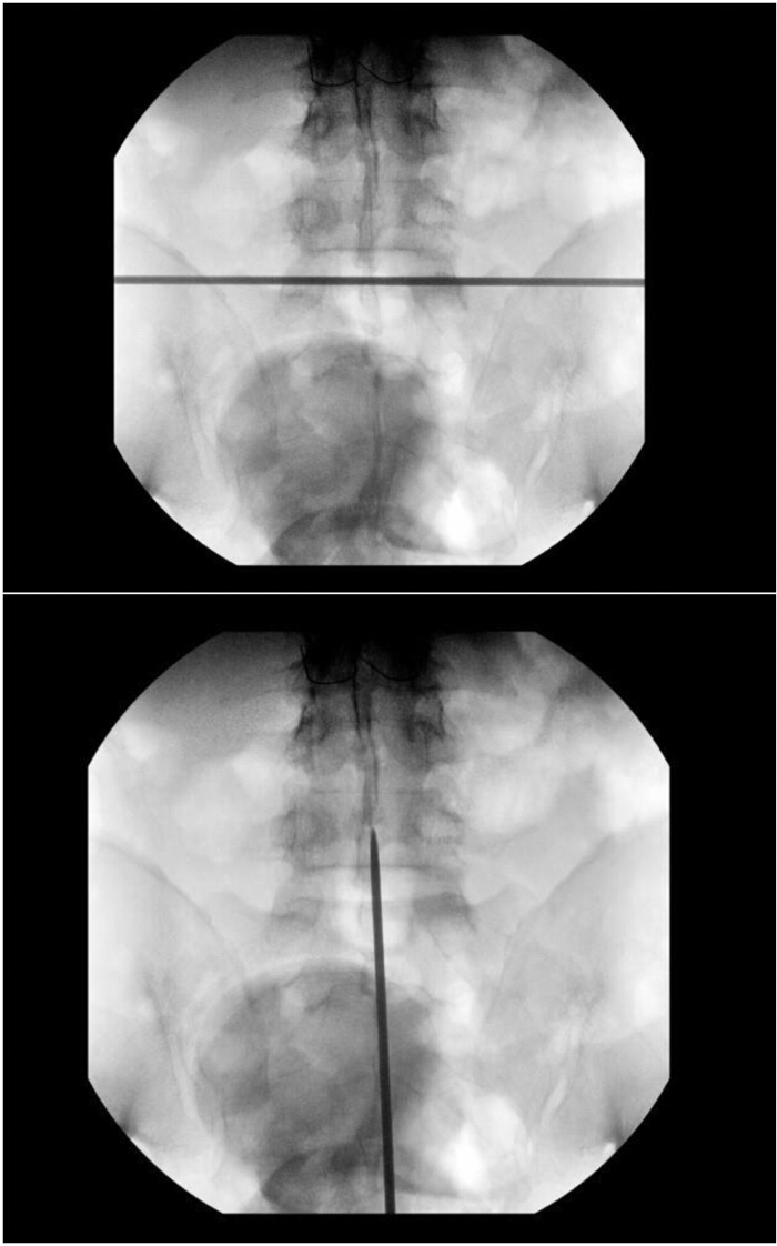 Spinal injection procedure fluoroscopy images, showcasing needle placement technique.