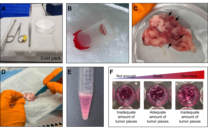 Tumor tissue dissection and analysis workflow: tools, sample preparation, and cell density results.