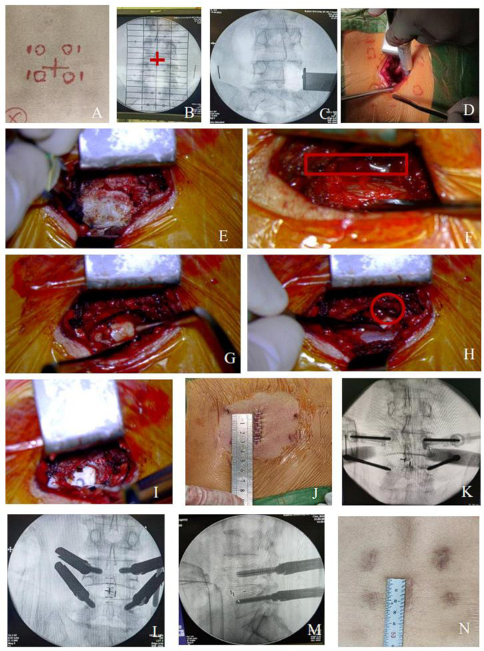 figure-results-1 Surgical procedure sequence, spinal instrumentation, fluoroscopy images, incision measurement, spine correction.