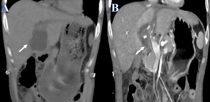 figure-introduction-1 Abdominal CT scan comparison, highlighting tumor pre- and post-treatment, medical imaging analysis.