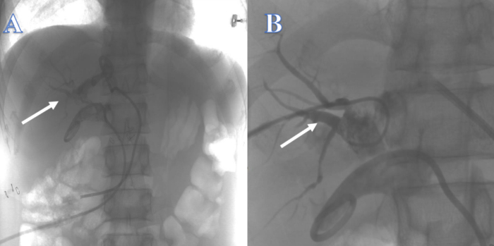 figure-introduction-2 X-ray angiography; heart catheterization; arterial flow; diagnostic analysis; medical imaging.