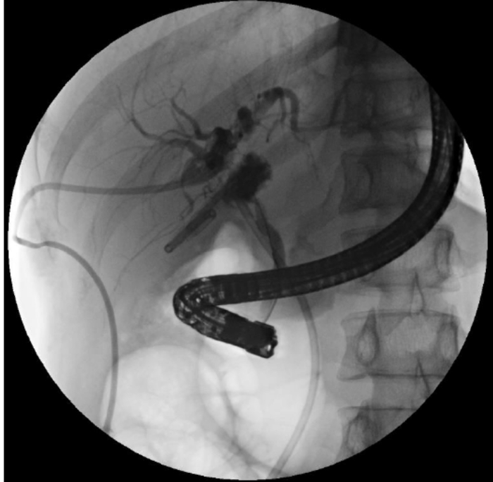 figure-introduction-3 Endoscopic retrograde cholangiopancreatography X-ray showing bile duct with endoscope placement.