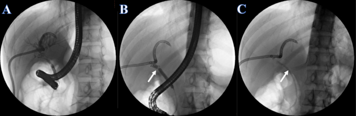 Endoscopic retrograde cholangiopancreatography (ERCP) steps, bile duct catheter insertion images.