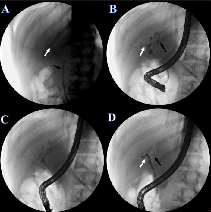 Endoscopy imaging shows bile duct procedure; arrows indicate catheter positions, anatomical detail.