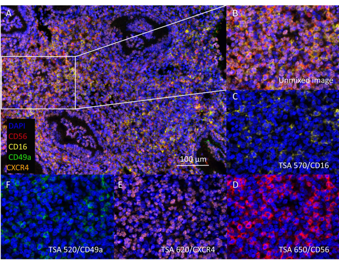 figure-results-3 Immunofluorescence multiplex labeling diagram; TSA method for CD56, CD16, CD49a, CXCR4 analysis.
