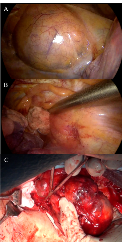Minimal Invasive Resection Of Large Retrosternal Thyroid Goiter 