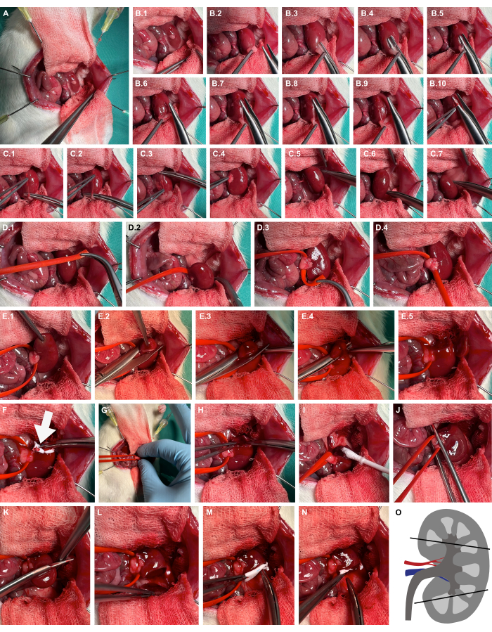 Surgical kidney transplantation process, step-by-step image showing dissection, vessel connection, organ placement.