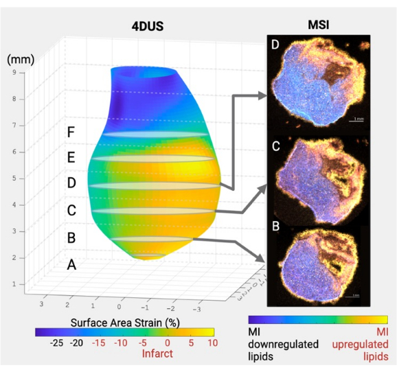 4DUS surface area strain chart with MSI lipid distributions; shows infarct to lipid regulation correlation.