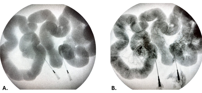 figure-results-6 Colonic transit study diagram with contrast medium showing GI tract motility assessment.