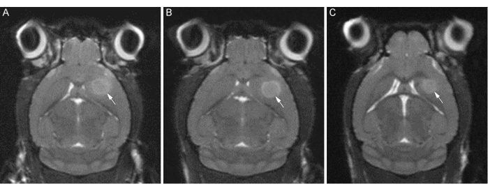 MRI brain scans showing tumor progression, axial view, diagnostic imaging analysis.