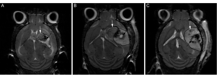 MRI brain scan sequence, tumor progression analysis, axial view, labeled regions A, B, C.