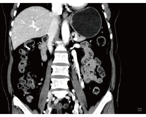 CT scan image showing abdominal organs, highlighting a large cystic mass above the liver.