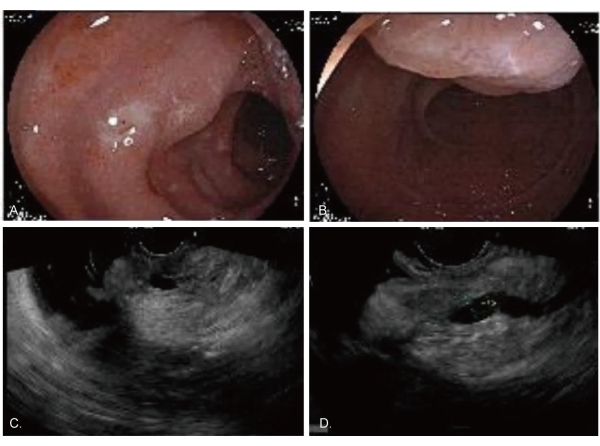 Colonoscopy and ultrasound imaging in gastrointestinal diagnostics; endoscopic views, sonogram images.