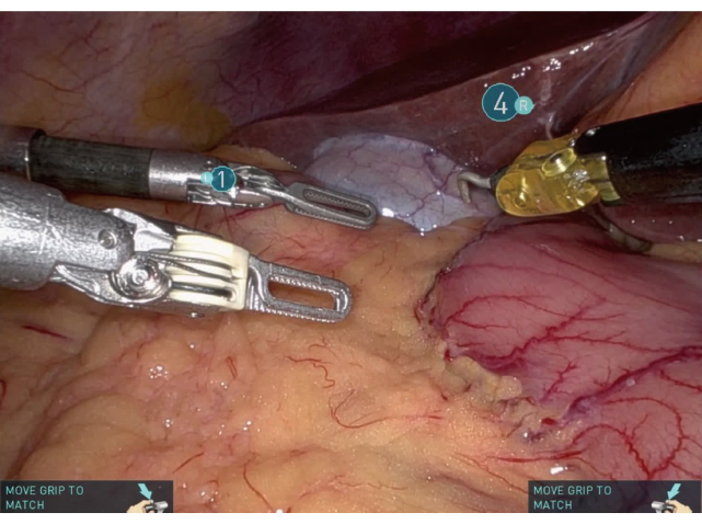 Robotic surgery setup in laparoscopic procedure; instruments manipulate tissue.
