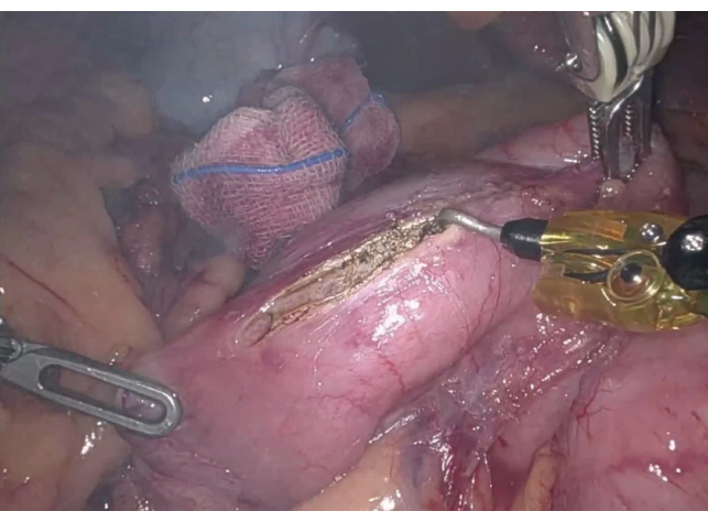 Surgical dissection using electrocautery in a medical procedure, displaying precise technique.