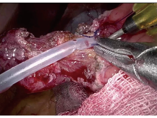 Surgical procedure, vascular anastomosis, close-up, medical instruments, tissue suturing.