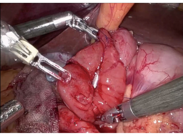 Robotic surgery procedure showing tissue manipulation with mechanical arms.