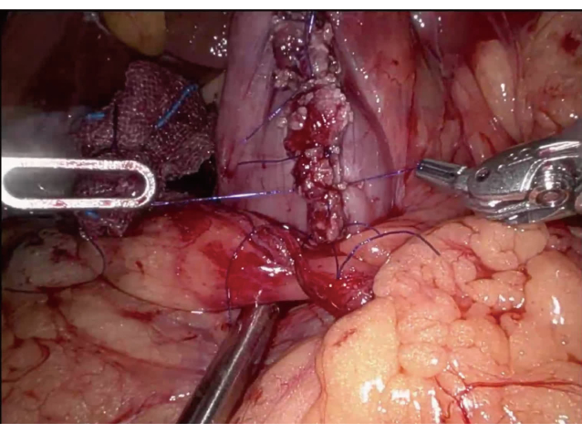 Surgical procedure with sutures and clamps; abdominal area; medical education.