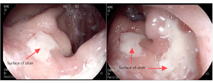 Endoscopy image showing gastric ulcer surface comparison.