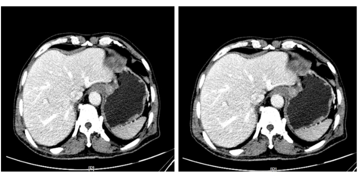 CT scan comparing liver cross-sections; diagnostic imaging, liver analysis, medical radiography.