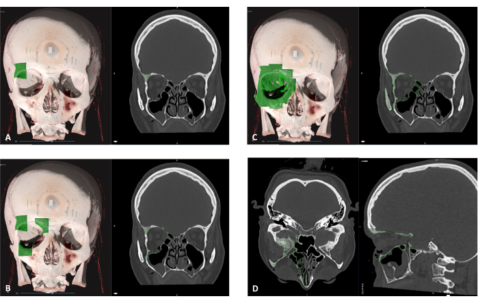 CT scan analysis diagram of cranial structure showing sinus area with highlighted assessment zones.