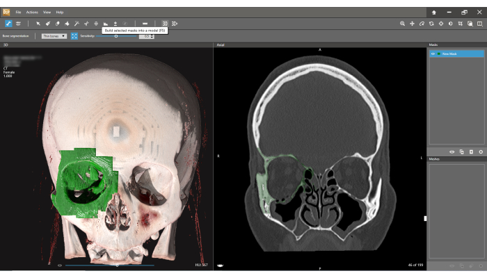CT scan analysis, 3D skull reconstruction, and cross-sectional diagram using imaging software.