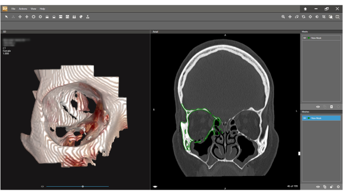 CT scan analysis; coronal section; 3D reconstruction; medical imaging; bone structure evaluation.