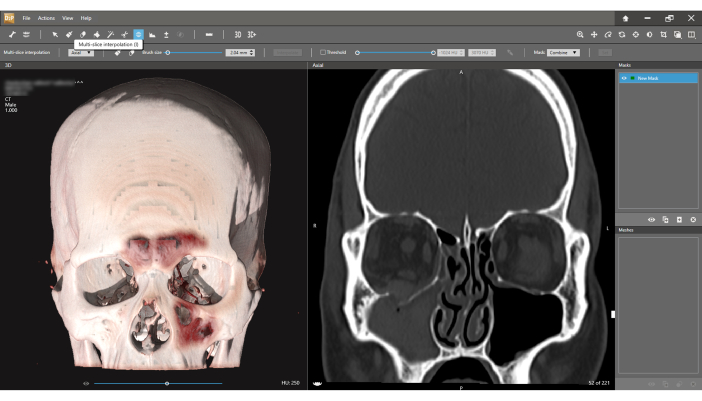 CT scan analysis, skull 3D rendering and axial view, medical imaging, diagnostic assessment.