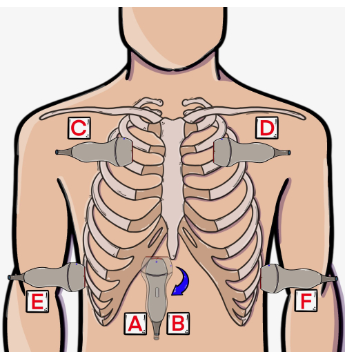 Ultrasound probe positioning diagram for lung examination, illustrating six major chest areas.