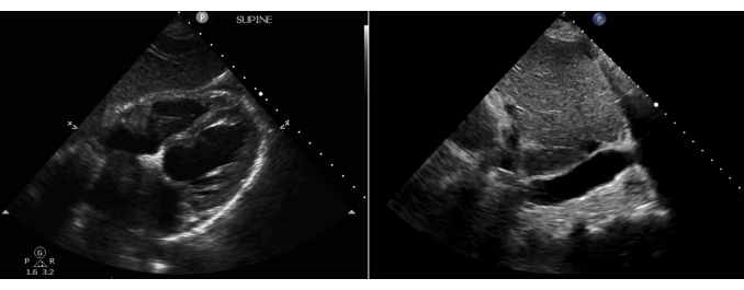 Ultrasound imaging, heart structure analysis; echocardiogram, clinical diagnosis, cardiac assessment.