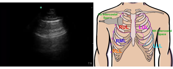 Lung ultrasound imaging and anatomical diagram highlighting rib intercostal spaces for probe placement.