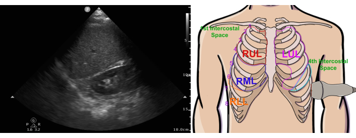 Lung ultrasound with anatomical diagram; intercostal spaces labelled for diagnostic reference.