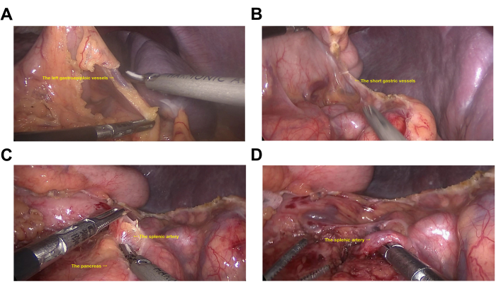 Laparoscopic surgery: dissecting gastric vessels; surgical instruments; medical procedure steps.
