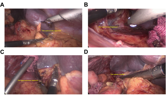 Surgical dissection process showing splenic ligaments; laparoscopic procedure; anatomical labels.