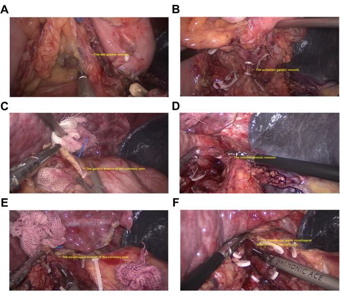 Laparoscopic vein dissection steps; gastric and coronary veins, vessels identification process.