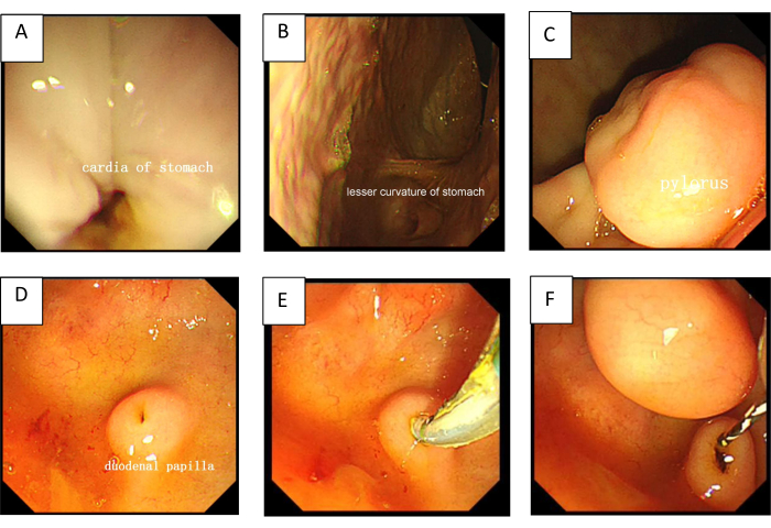 figure-results-1 Endoscopy images of stomach anatomy; includes cardia, pylorus, and duodenum.