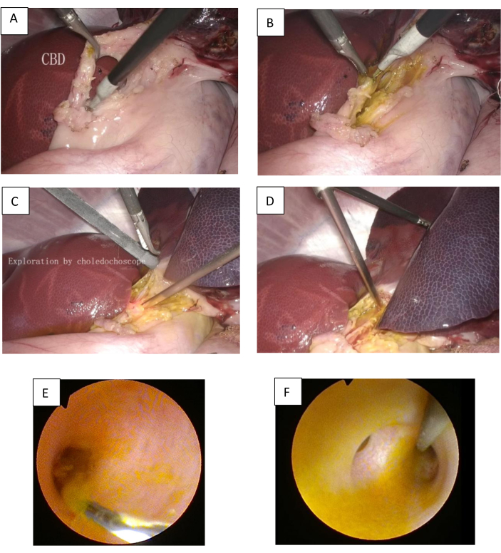 figure-results-3 Cholangiography procedure with choledochoscope; laparoscopic liver exploration steps.