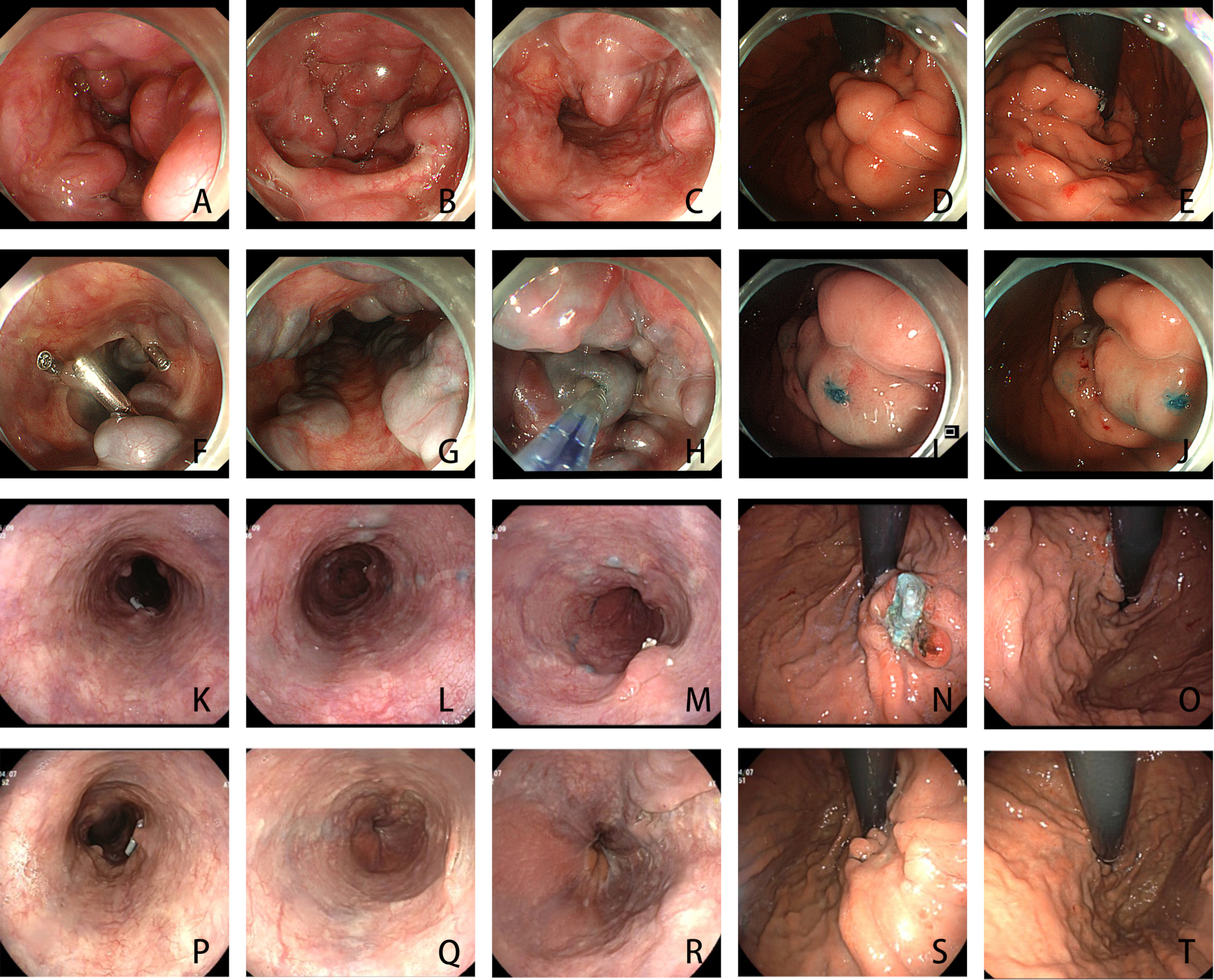 Endoscopic Injection Sclerotherapy Assisted by Cyanoacrylate and Clips ...