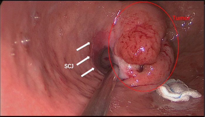 Endoscopy showing tumor visualization at squamocolumnar junction (SCJ) in esophagus examination.