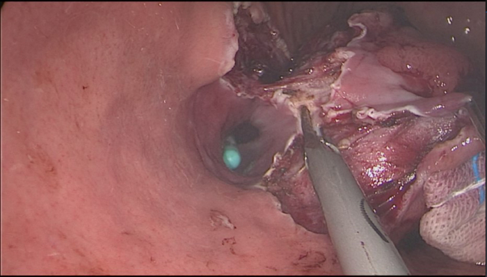 Esophageal endoscopy procedure showing biopsy tool extracting tissue sample for analysis.