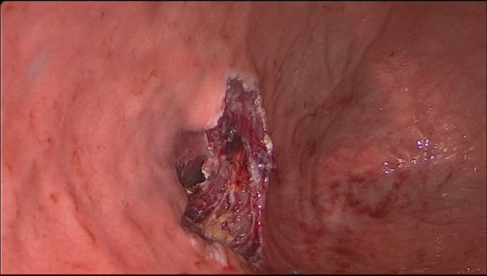 Colonoscopic image of ulcerated lesion in gastrointestinal tract, used for diagnostics study.