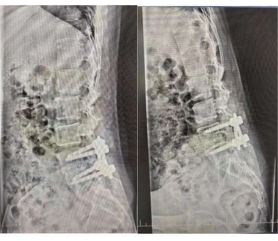 Spine with surgical screws; X-ray image; post-operative spine stabilization study.