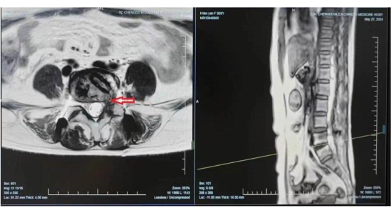 MRI scans displaying spinal cross-section and sagittal views; arrows indicate lumbar herniation.