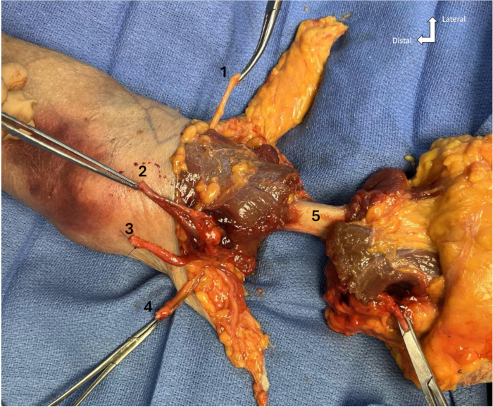 figure-protocol-1 Surgical procedure diagram; labeled anatomy of forearm and elbow region during dissection.
