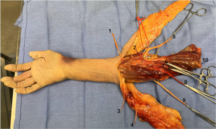 figure-protocol-2 Human arm dissection, displaying labeled nerves and muscles, anatomical study, educational diagram.
