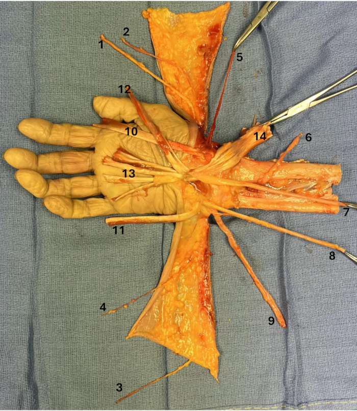 figure-protocol-5 Anatomy dissection: hand dissection with nerves and tendons exposed, illustrating detailed structure.
