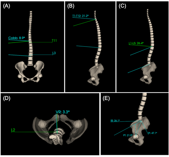 figure-results-6 Spinal curvature diagrams with Cobb angles and vertebral rotations for scoliosis analysis.