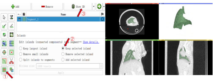 figure-protocol-5 CT scan segmentation software interface, 3D model, island editing, medical imaging analysis.